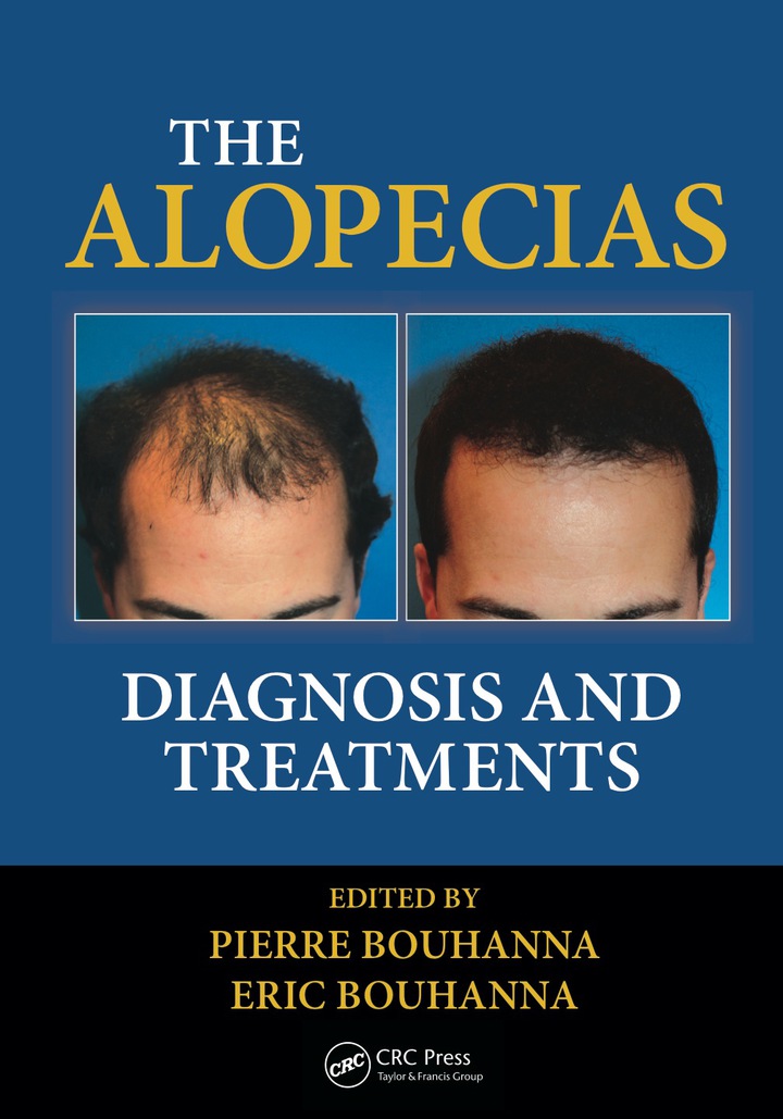 The Alopecias: Diagnosis and Treatments