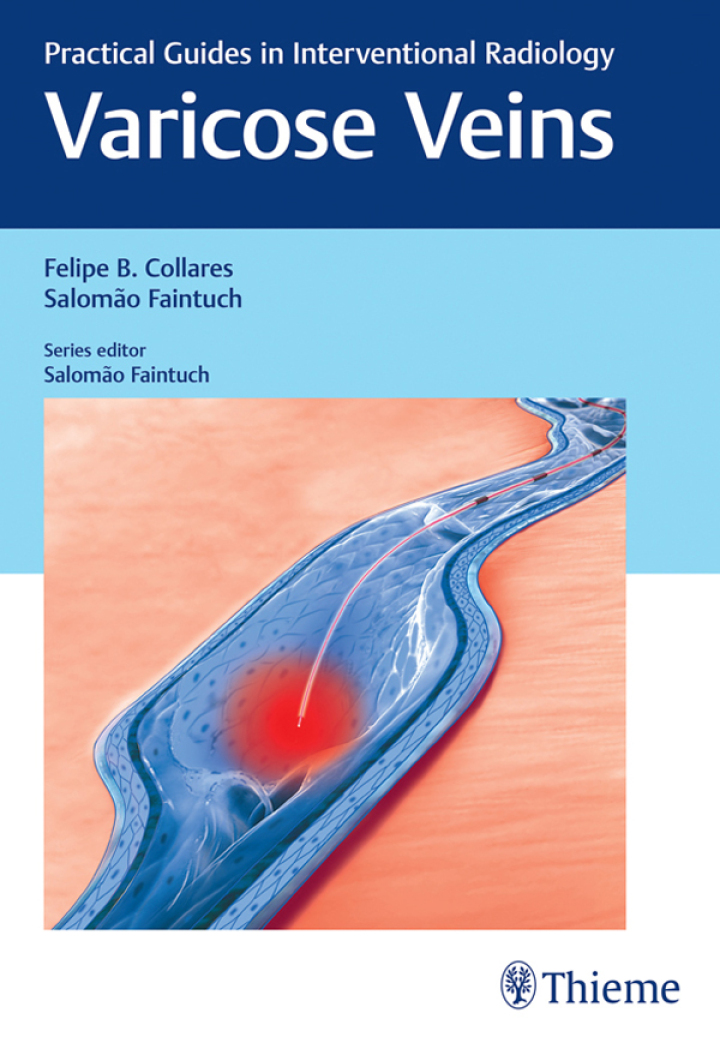 Varicose Veins: Practical Guides in Interventional Radiology